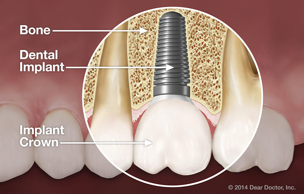 Basal dental implants inchennai Basal implantology in india Advantages
