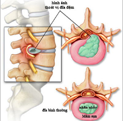 Bệnh thoát vị đĩa đệm