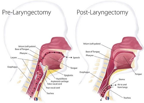 Laryngectomy Anatomy laryngectomy-anatomy
