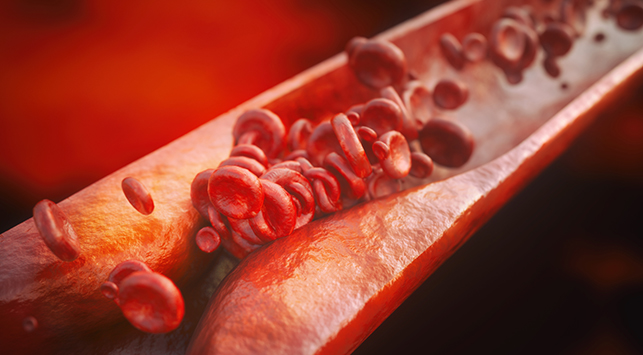 Gejala , Penyebab , Pencegahan Aterosklerosis