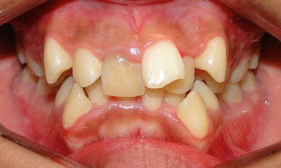 Có nên bọc răng sứ khi răng lệch lạc?