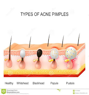 types of acne