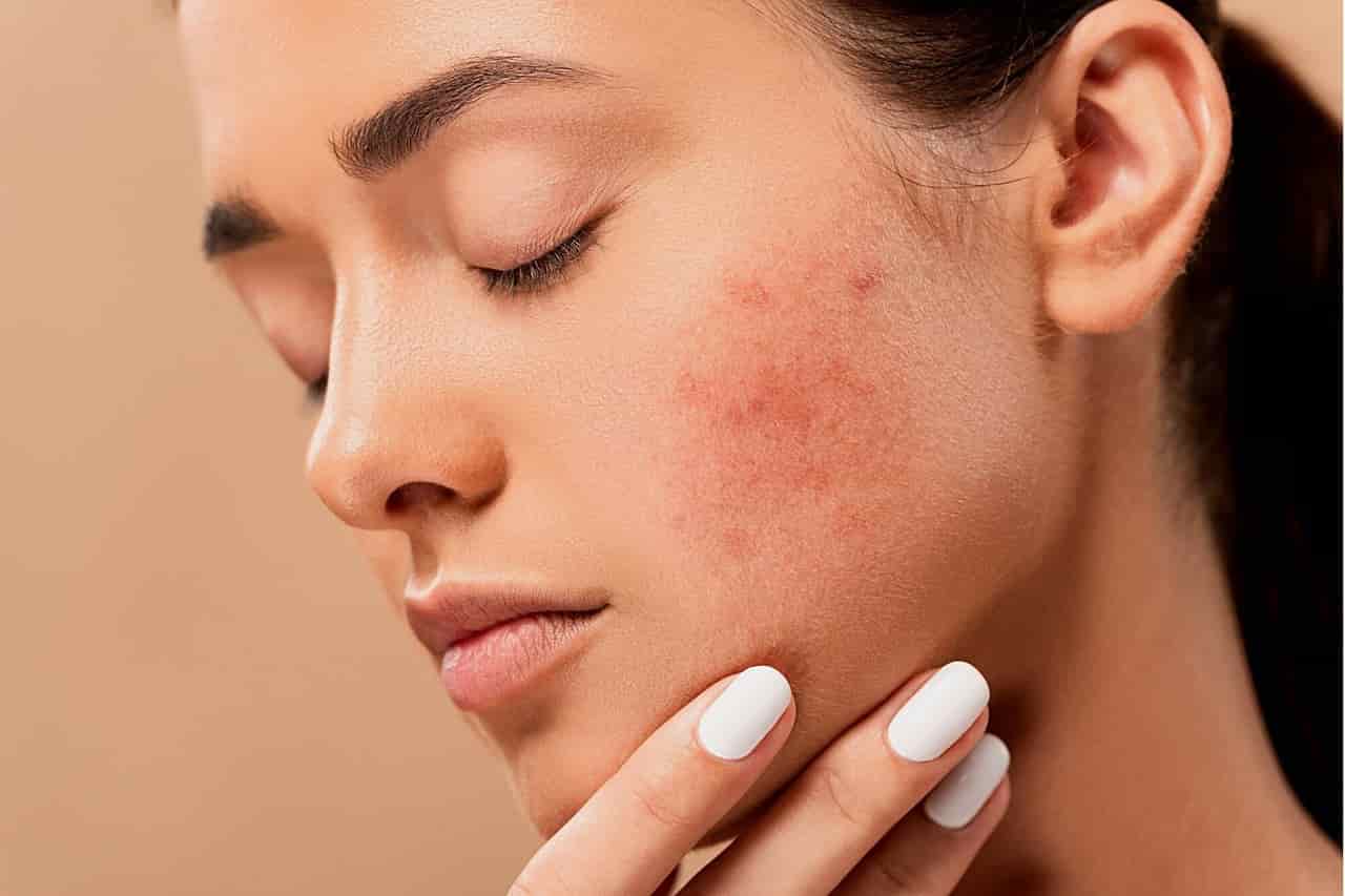 Get Rid Of Pimples Overnight In 3 Steps.