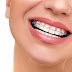 Nguyên nhân và cách khắc phục răng mọc chen chúc