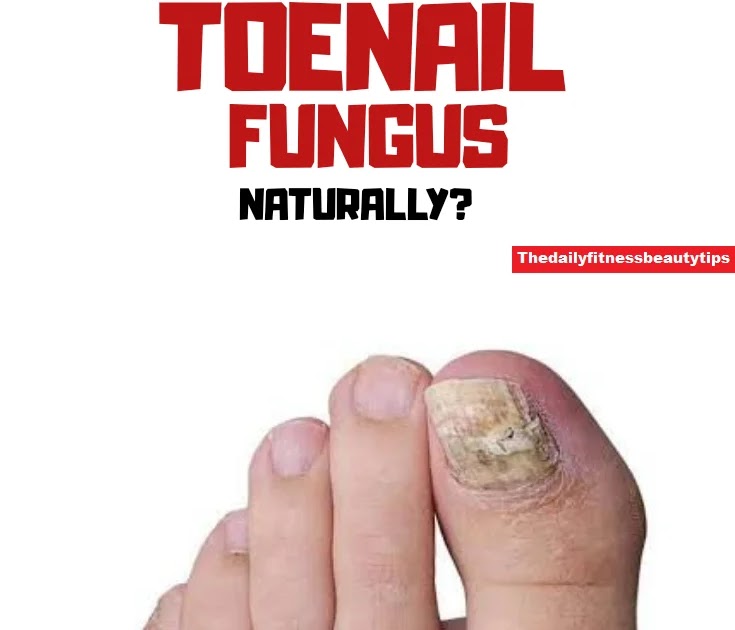How To Get Rid Of Toes Nail Infection Fast?