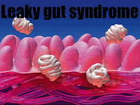 leaky gut syndrome