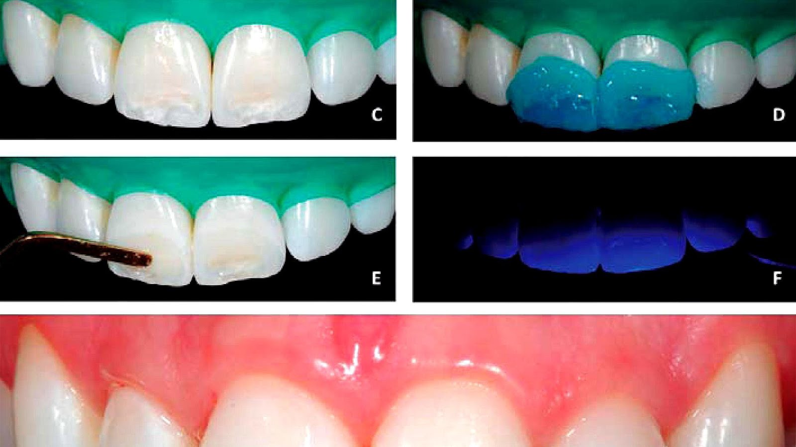 how-to-get-rid-of-yellow-spots-on-teeth-yellow-choices