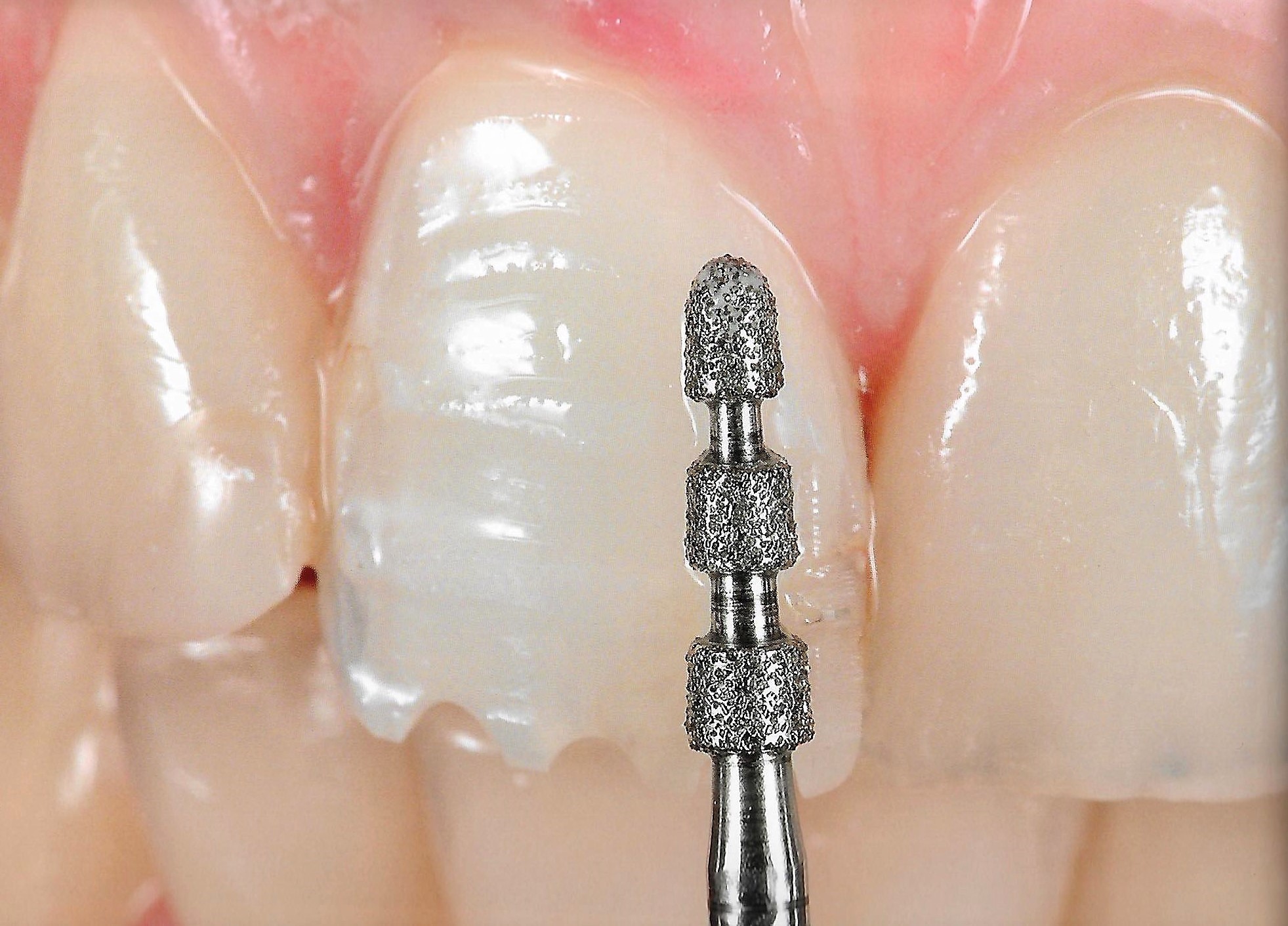 Ceramic veneers preparartion .. Part 2 " Conventional preparation