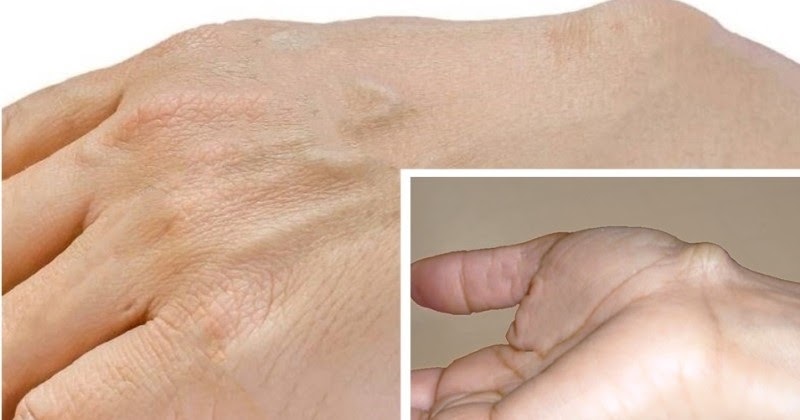 ganglion cyst removal surgery or simply needle aspiration