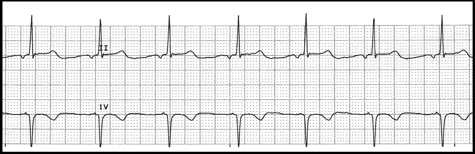 Float Nurse: Basic EKG Test 59