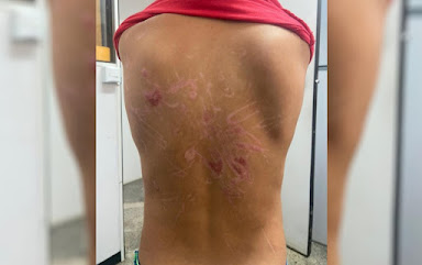 Menino de 8 anos exibe ferimentos nas costas que sofreu após sessões de tortura, em Goiânia, Goiás — Foto: Divulgação/Polícia Civil