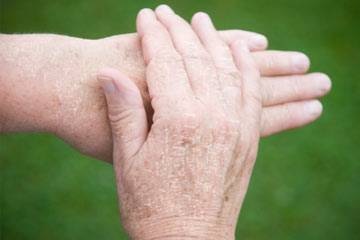dry hands skin arms extremely problems bumpy rid causes cracked winters health often drier become age md suffer don