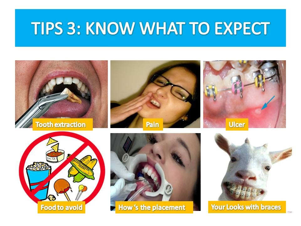 braces before need expect
