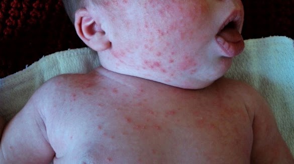 baby acne on chest