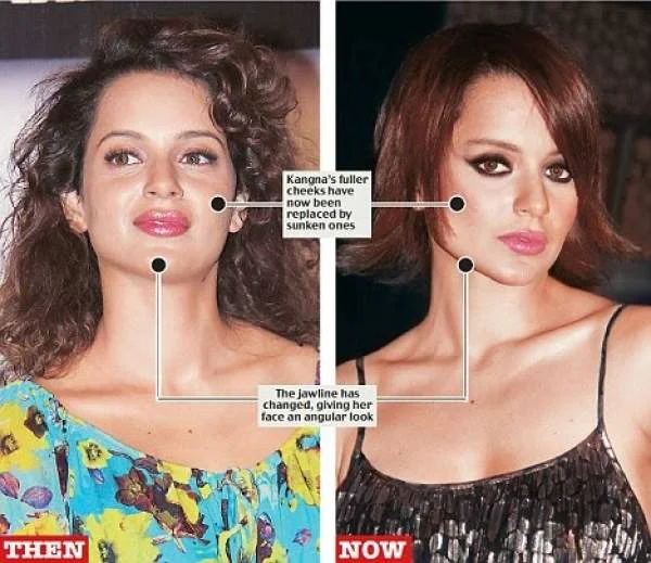 कंगना रनौत plastic surgery now and then