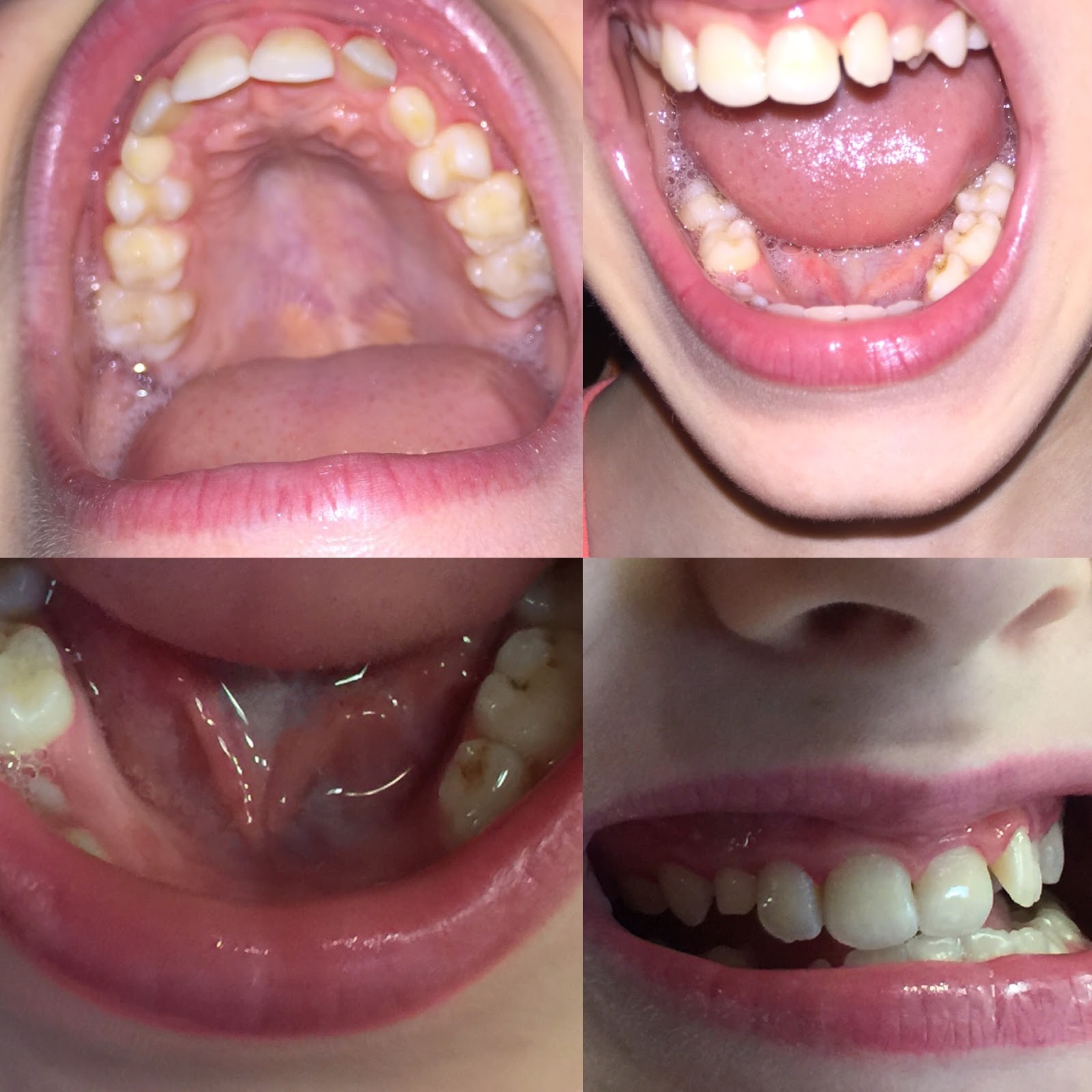 The REAL Deal 5 cavities HEALED in Autistic Child YES YOU CAN see 