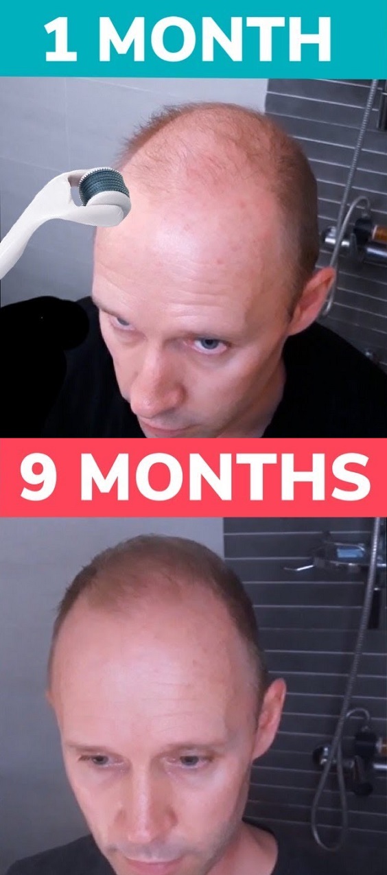 Does a Derma Roller Work For Hair Loss? Beautypro Club