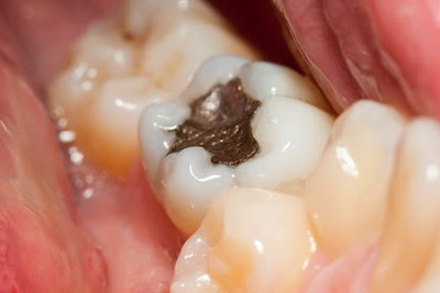 Quy trình trám răng bị sâu nặng