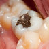 Quy trình trám răng bị sâu nặng