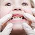 Cara Mencegah Gigi Keropos & Berkarang Untuk Kembalikan Sensasi Percaya Diri