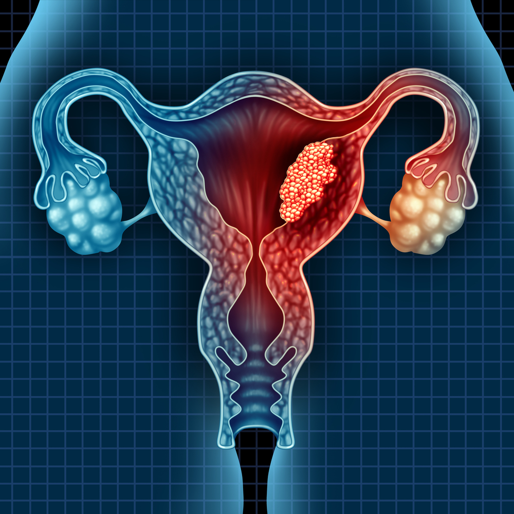 O que a endometriose pode causar? - Seja Hoje Diferente