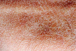 Acanthosis Nigricans - Symptoms and Causes of Acanthosis Nigricans 
