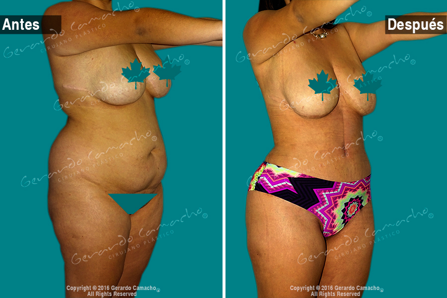 Lipectomia abdominal antes y despues de adelgazar