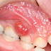 Chân răng sâu bị sưng có nguy hiểm không?