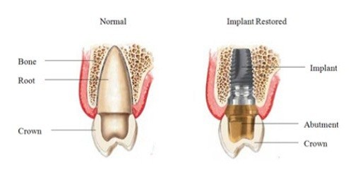 LƯU Ý CỰC KỲ QUAN TRỌNG BẠN CẦN NẮM RÕ KHI CẤY GHÉP IMPLANT -2