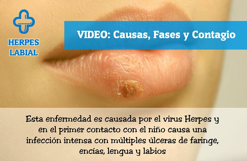 HERPES LABIAL Causas, Fases y Contagio OdontoFarma