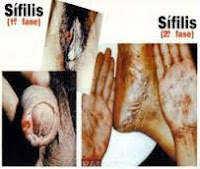 Obat Sipilis Terbukti Ampuh Sembuh 3 Hari