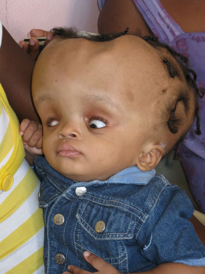 misshapen head in baby misshapen head in baby