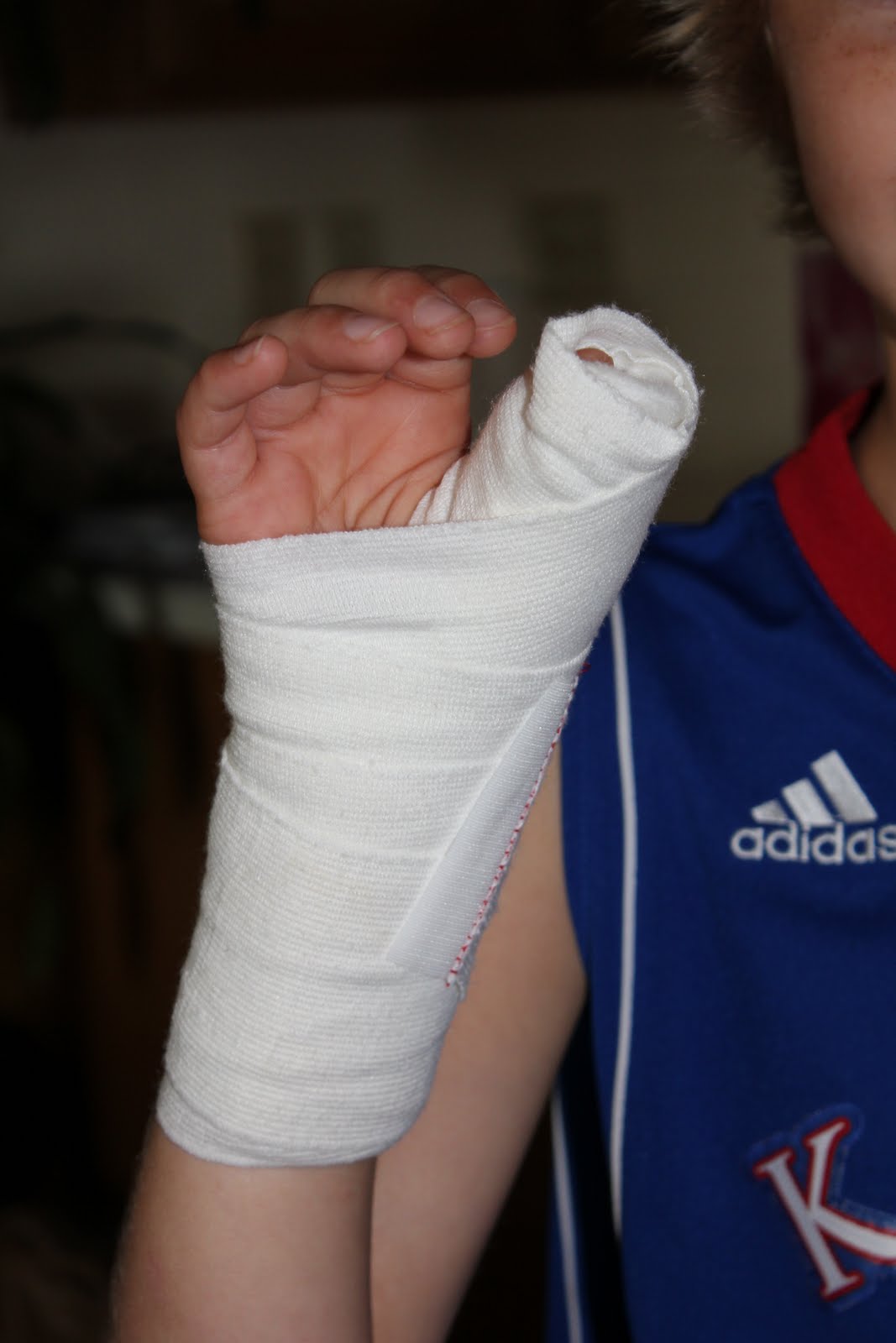 About to be More! A Broken Thumb