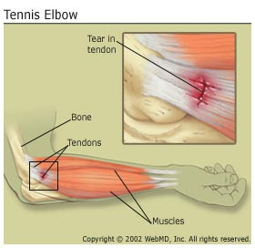 Tenis Elbow Hastalığı