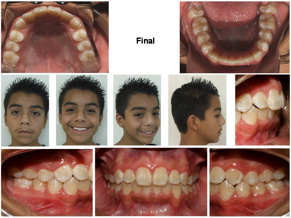 Orthodontist in Nuevo Progreso Brackets THE IMPORTANCE OF AN