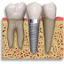 Implante Dentário: É mais fácil fazer do que você imagina...