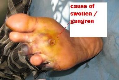 Diabetes patient's log after foot gangren operation