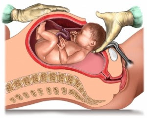 Cesarea libro obstetricia