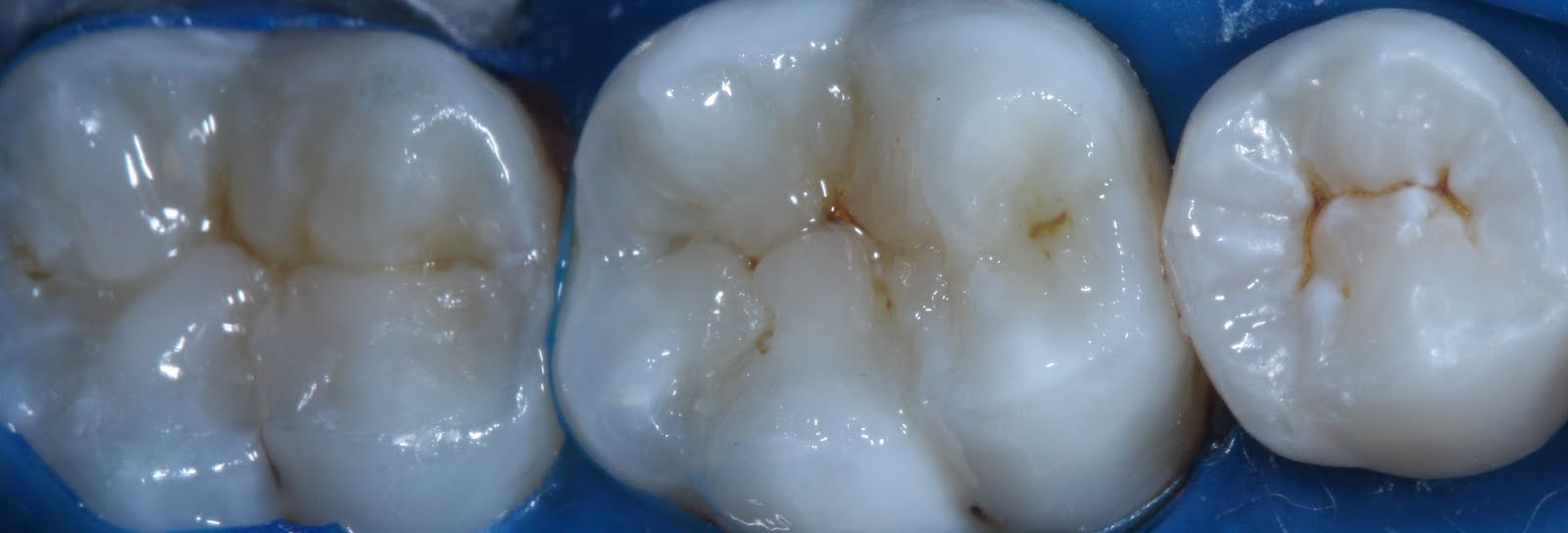 Restauração Estética ~ Araújo e ginger - Odontologia Estética