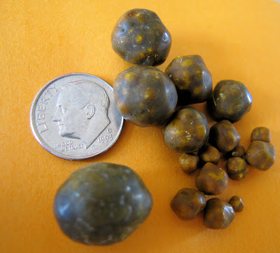 Surgeon removes 12,000 GALL STONES from a woman Stomach pain, Stomach, How to st