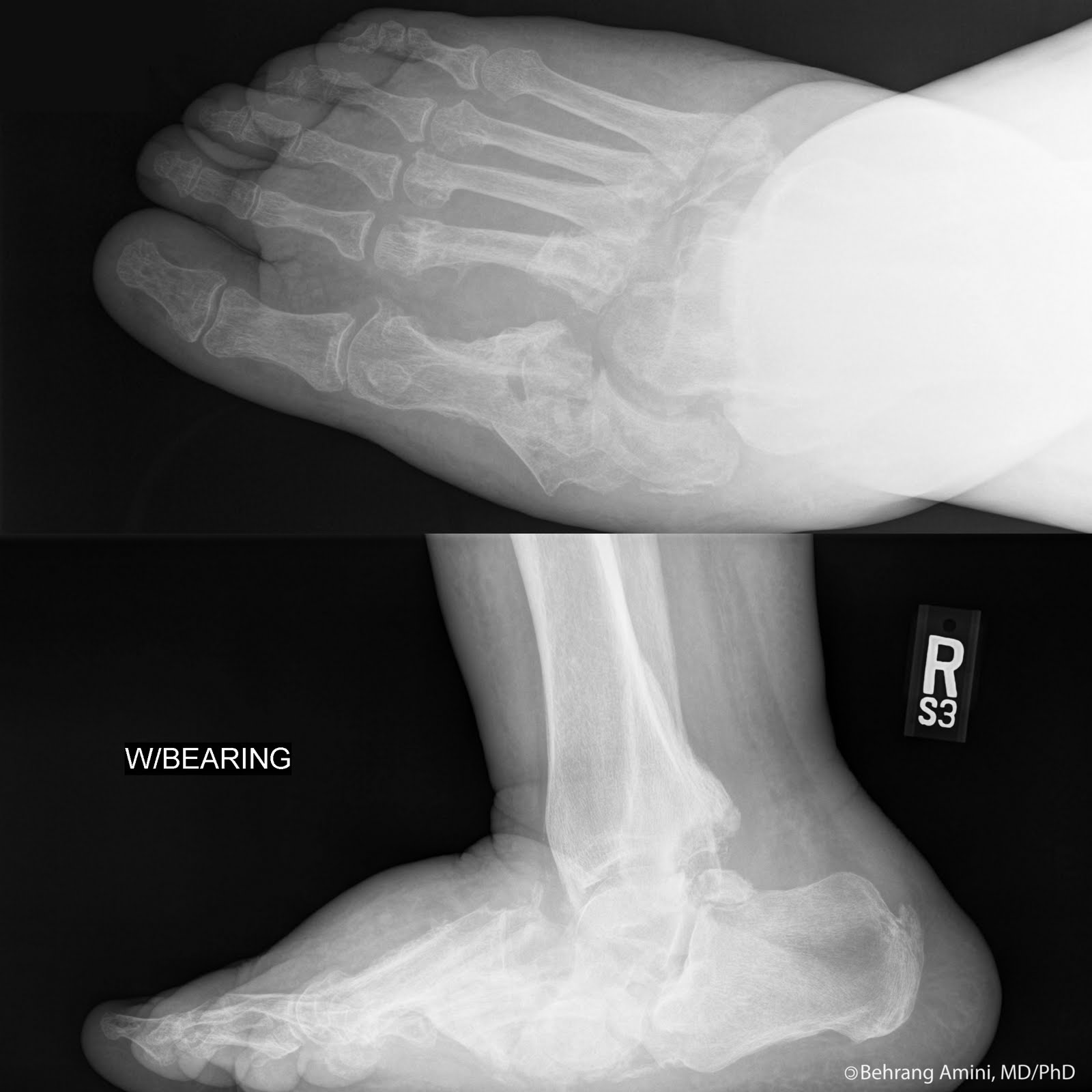 Roentgen Ray Reader Neuropathic (Charcot) Arthropathy