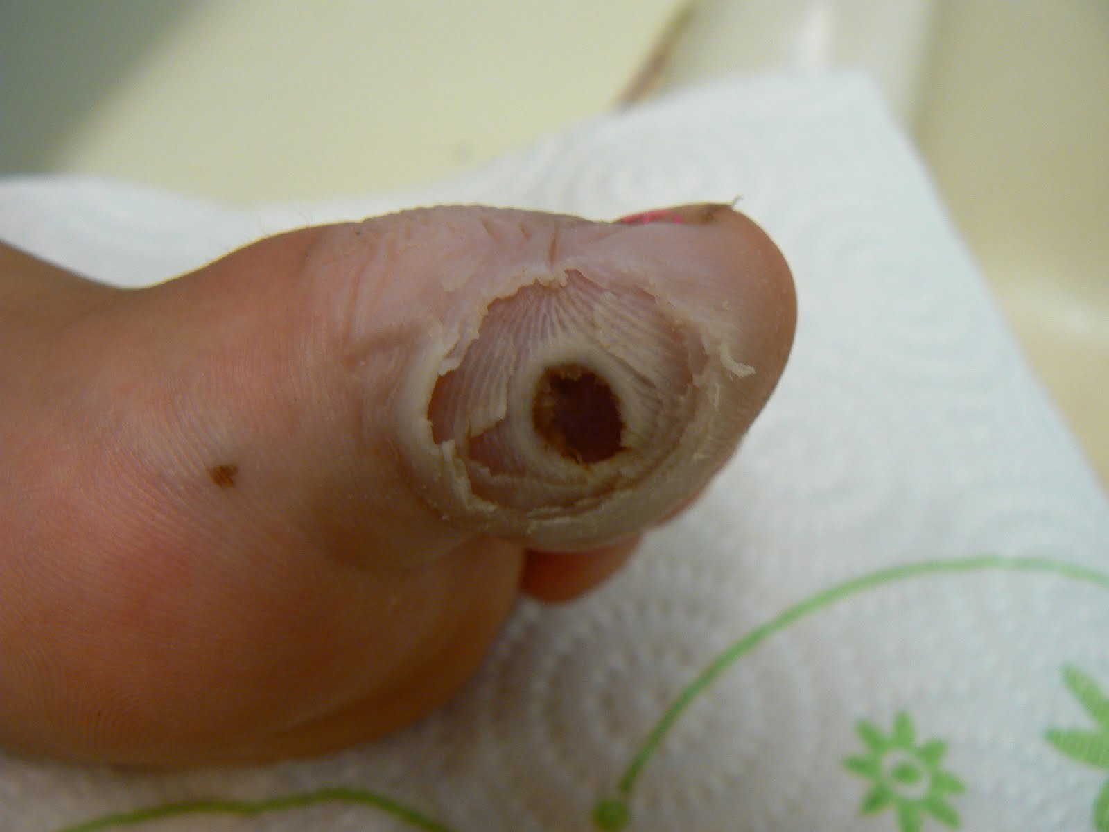 Plantar Wart Compound W