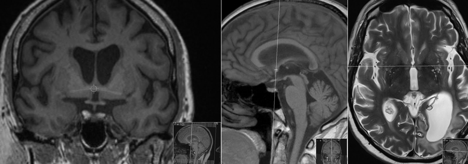 Commissore Drop Anterior And Posterior Commissure – ZXXQC