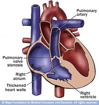 Cross Healed Hearts: Pulomonary Valve Stenosis