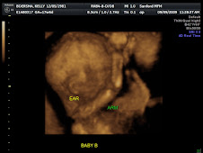 Baby B 3D at 18 weeks