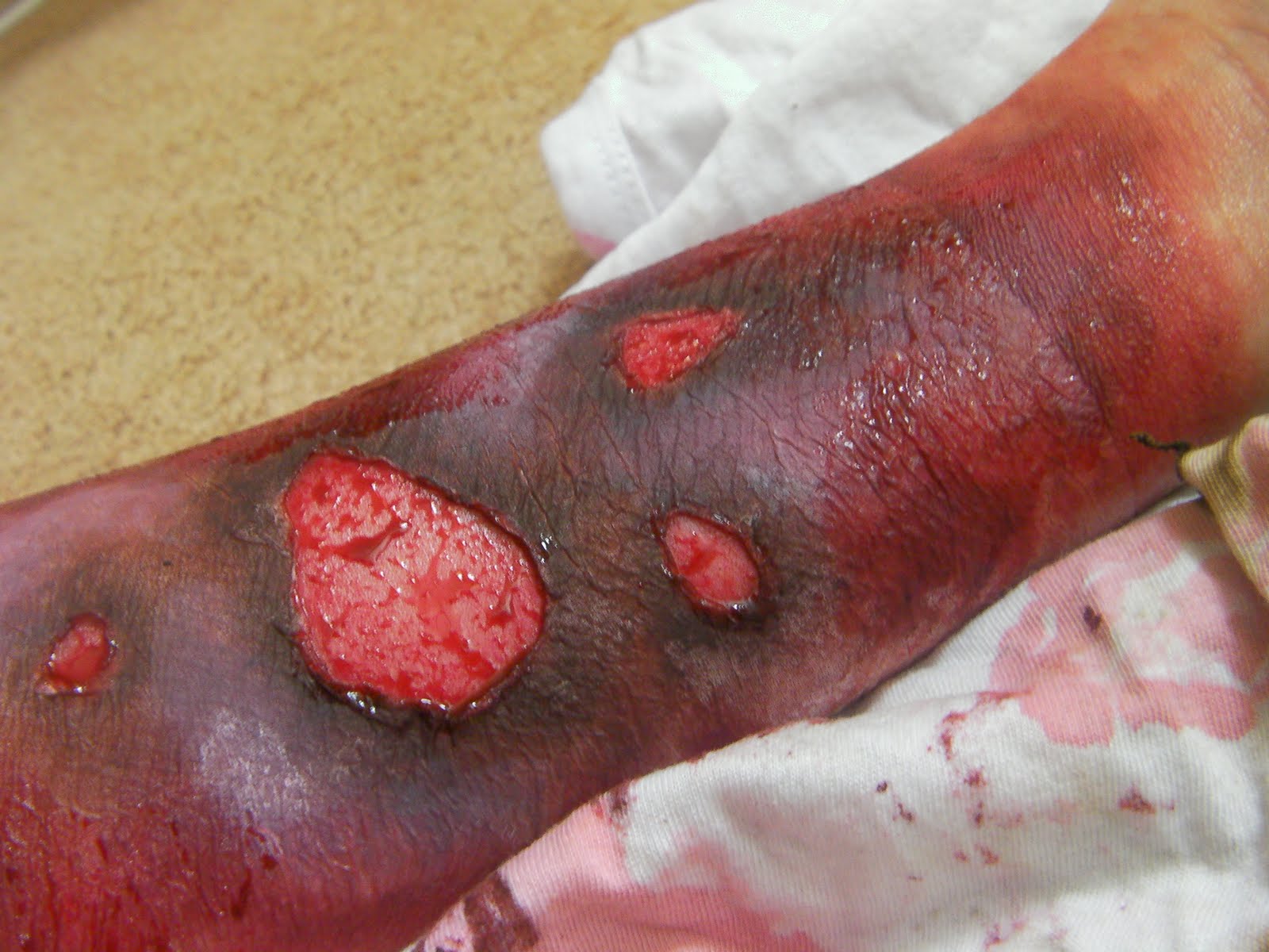 Third-Degree Burn in Children - Health Encyclopedia ...