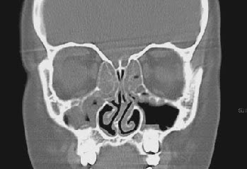 sinusitis research paper Sinusitis is one of the most common diagnoses in primary care it causes substantial morbidity, often resulting in time off work, and is one of the commonest reasons. sinusitis research paper Sinusitis is one of the most common diagnoses in primary care it causes substantial morbidity, often resulting in time off work, and is one of the commonest reasons.