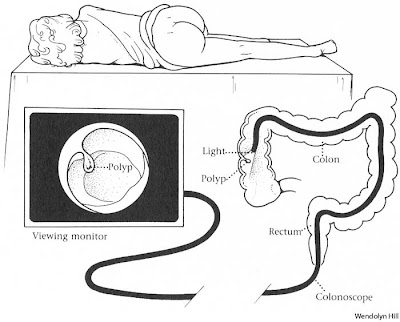 colonoscopy wiki