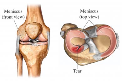 [medial+meniscus.jpg]