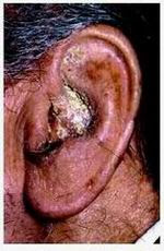 Enfermeria Del Adulto Y El Anciano Sabia Ud Que Es La Otitis